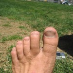 Ken Bob’s stubbed toe (2007 July 29) San Francisco Marathon