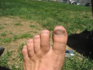 Ken Bob's stubbed toe (2007 July 29) San Francisco Marathon