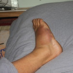 Ken Bob's Injured Foot!!